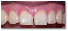 Cierre de diastema interincisivo — antes