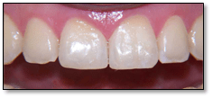 Cierre de diastema interincisivo — después