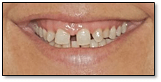 Cirugía estética gingival — antes