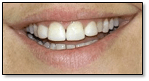 Cirugía estética gingival — después