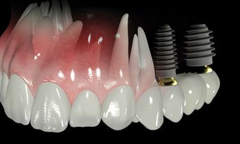 Implantología Oral